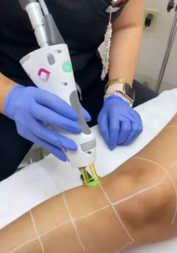 Laser hair removal performed on legs at Accesa Health