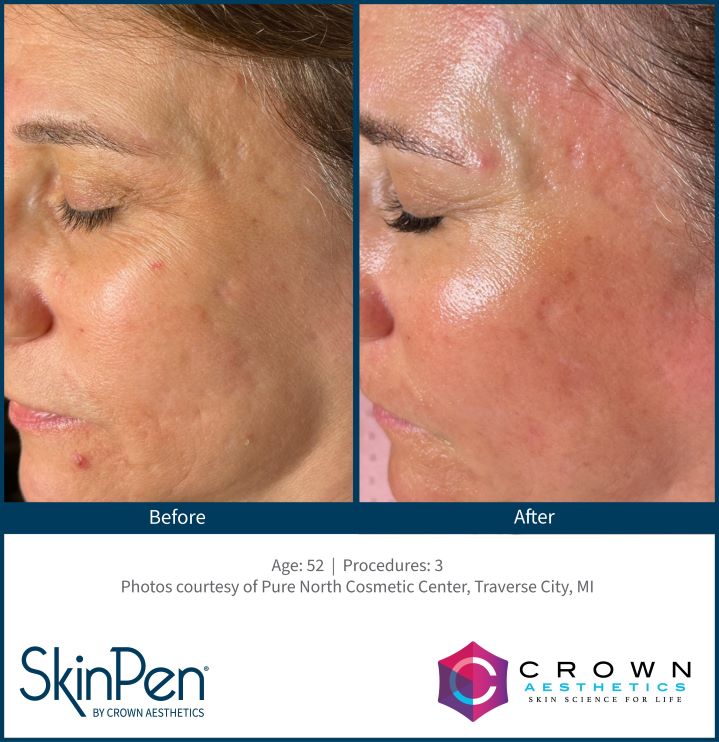 SkinPen Before & After