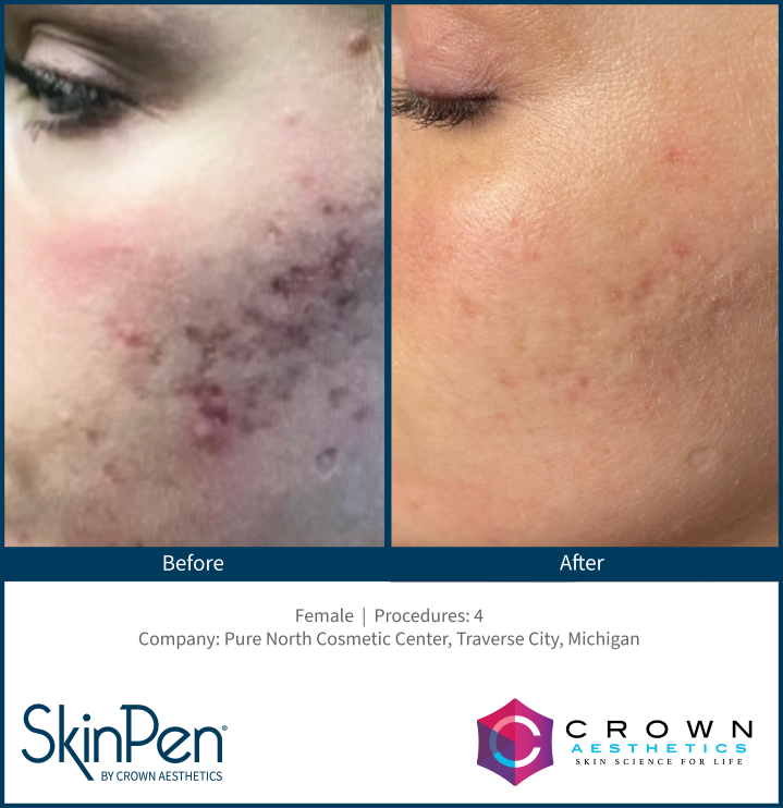 SkinPen Microneedling Before & After